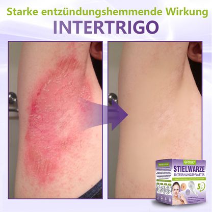 GFOUK® Lösliches Mikronadel-Pflaster zur Entfernung von Hautanhängseln auf Pflanzenbasis☘️