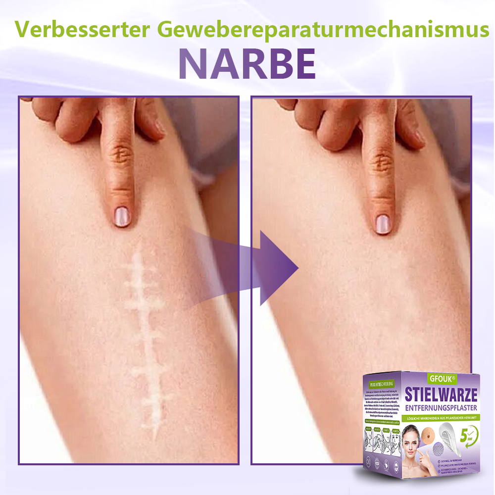 GFOUK® Lösliches Mikronadel-Pflaster zur Entfernung von Hautanhängseln auf Pflanzenbasis☘️