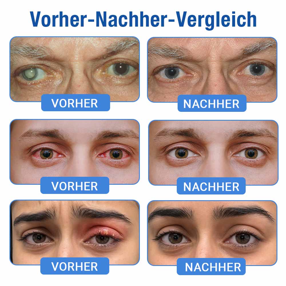 👨‍⚕️ DR.Fachmer® LensClarity Augentropfen✅Ideal bei trockenen Augen, verschwommener Sicht & Alterssichtigkeit 🍃