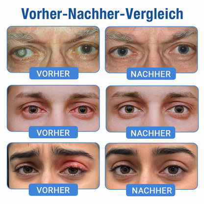 👨‍⚕️ DR.Fachmer® LensClarity Augentropfen✅Ideal bei trockenen Augen, verschwommener Sicht & Alterssichtigkeit 🍃