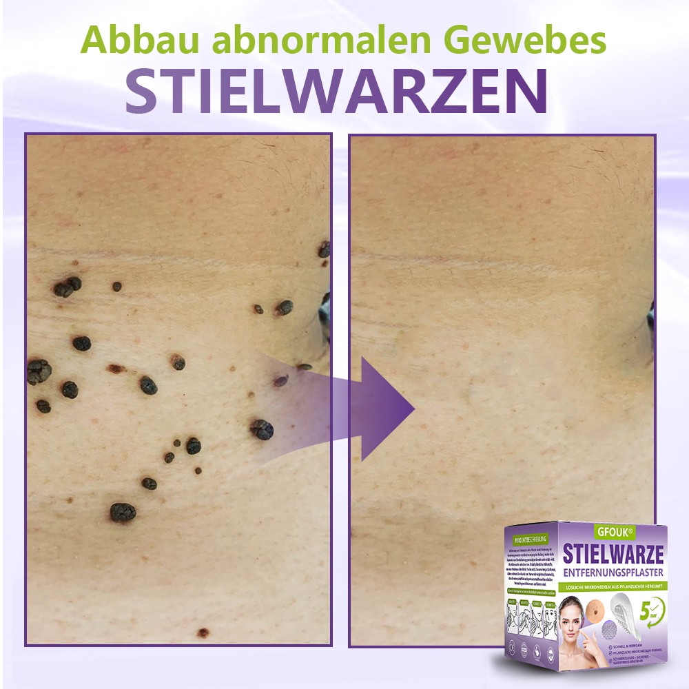 GFOUK® Lösliches Mikronadel-Pflaster zur Entfernung von Hautanhängseln auf Pflanzenbasis☘️