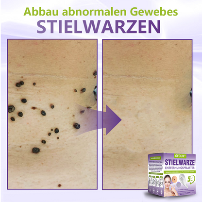 GFOUK® Lösliches Mikronadel-Pflaster zur Entfernung von Hautanhängseln auf Pflanzenbasis☘️