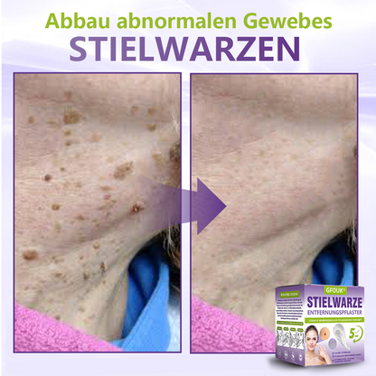 GFOUK® Lösliches Mikronadel-Pflaster zur Entfernung von Hautanhängseln auf Pflanzenbasis☘️