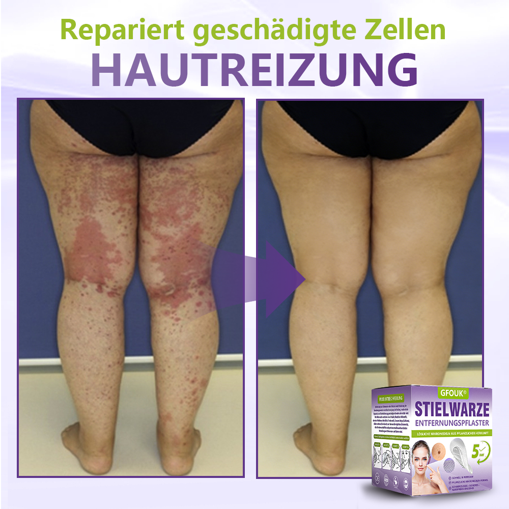 GFOUK® Lösliches Mikronadel-Pflaster zur Entfernung von Hautanhängseln auf Pflanzenbasis☘️