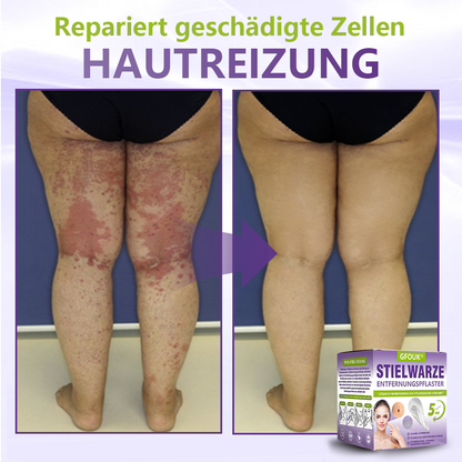 GFOUK® Lösliches Mikronadel-Pflaster zur Entfernung von Hautanhängseln auf Pflanzenbasis☘️