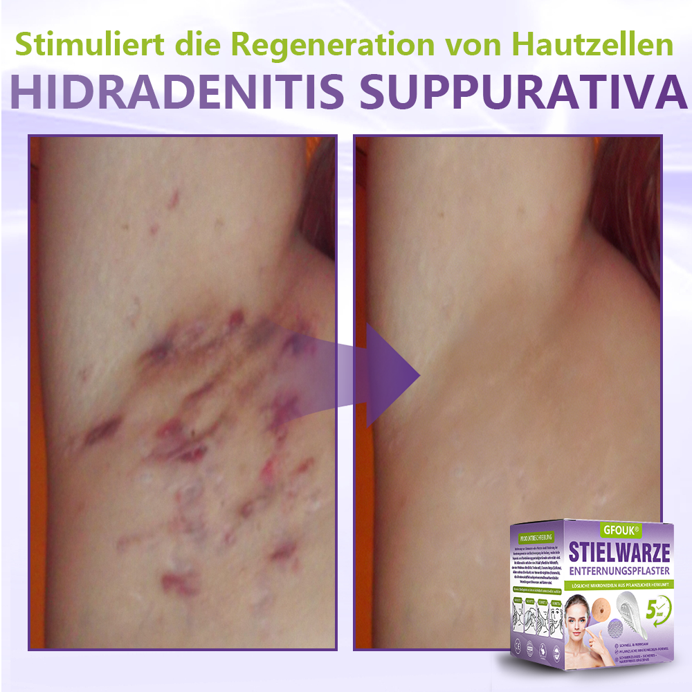 GFOUK® Lösliches Mikronadel-Pflaster zur Entfernung von Hautanhängseln auf Pflanzenbasis☘️